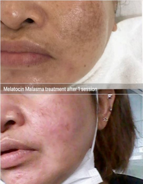 Before & after Melasma
